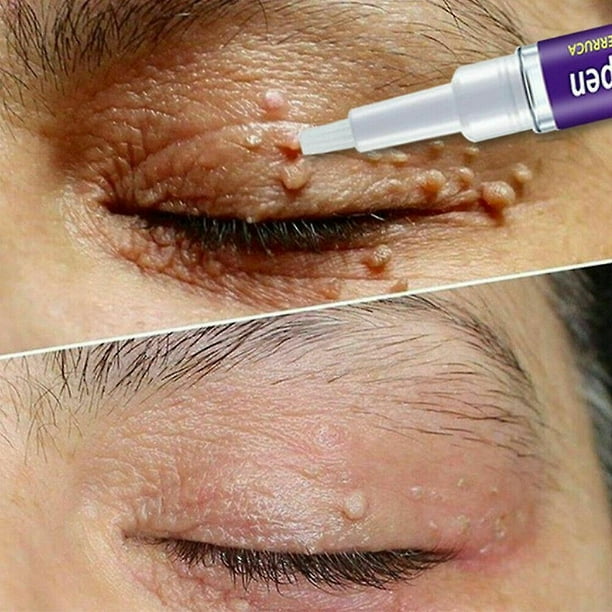 EELHOE Wart Removing Pen – Fast & Safe Wart Removal Treatment